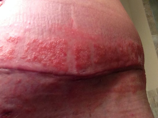 5 days PO - allergic reaction to dermabond : r/tummytucksurgery