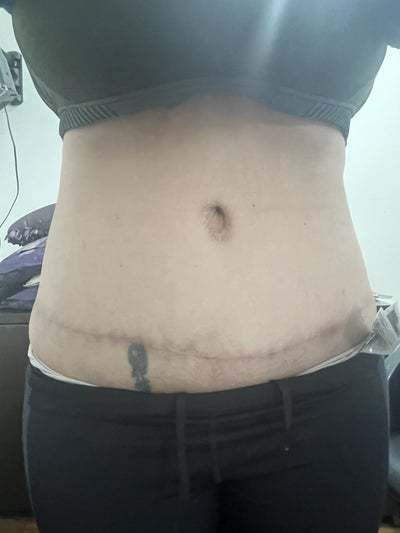 Belly Button Revision After Tummy Tuck