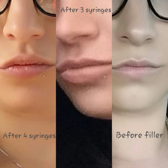 Lip Injections Before And After 1 2 Syringe | Lips Makeupview
