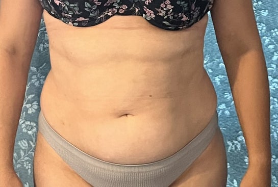 Can I combine endometriosis and scar removal with a mini tummy