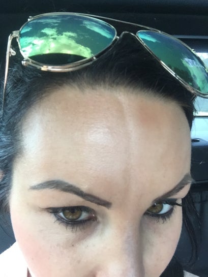 Dent in head sales from sunglasses