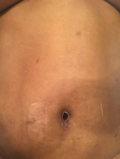 Open belly button hole following Tummy tuck is this normal photos