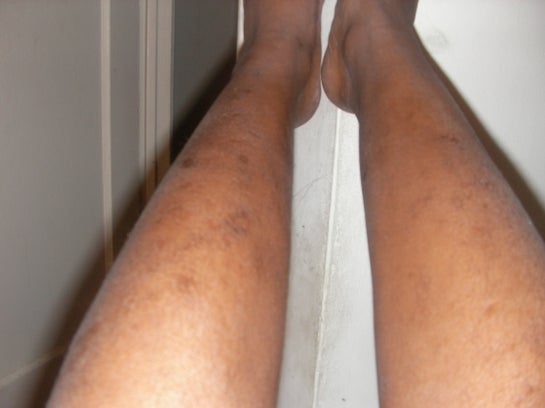 What is the best scar removal cream for black spots on the legs?