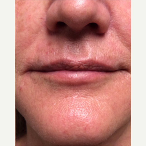 Larson Medical Aesthetics Burien Burien Washington Realself