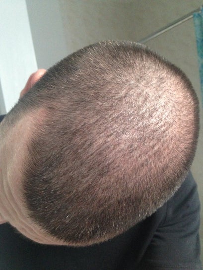 Why am I getting thin bald lines on my head? (photos)