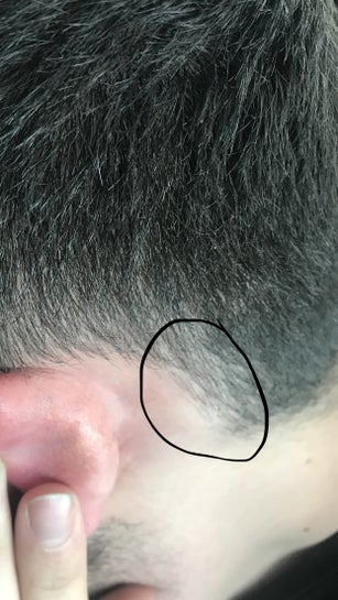 Swollen Occipital Lymph Node Behind Ear After Prp And Acell For Hair Restoration Procedure Advice Photos
