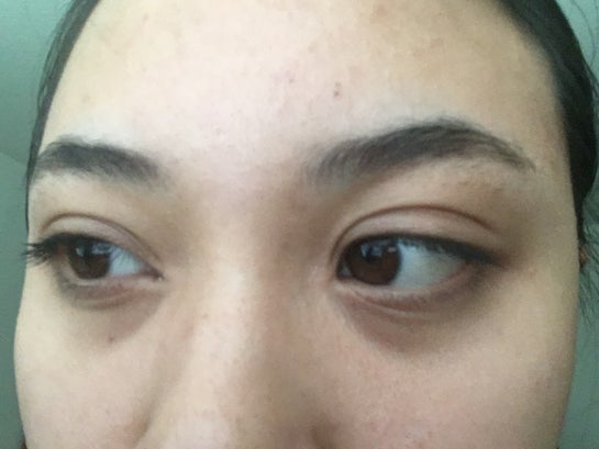 Sudden double hotsell eyelid