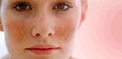 glutathione injection process What is the best to remove dark patches in my face? Can I have glutathione  injections for melasma? (Photo)