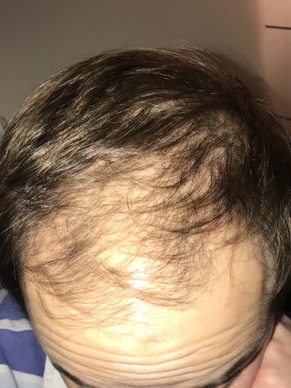 Crown Transplant Results - 1000 FUE/DHT Grafts, 6-Months update @Eugenix  Hair Sciences | Hair loss Forum - Hair Transplant forums