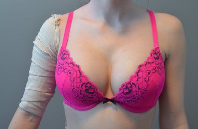 What size/profile to go from 32C to 32DD? (Photo)