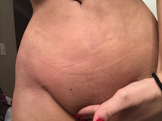I had a BBL 10 days ago. My pubic mound and my lower abdomen are huge. Will  this go away soon? (Photo)