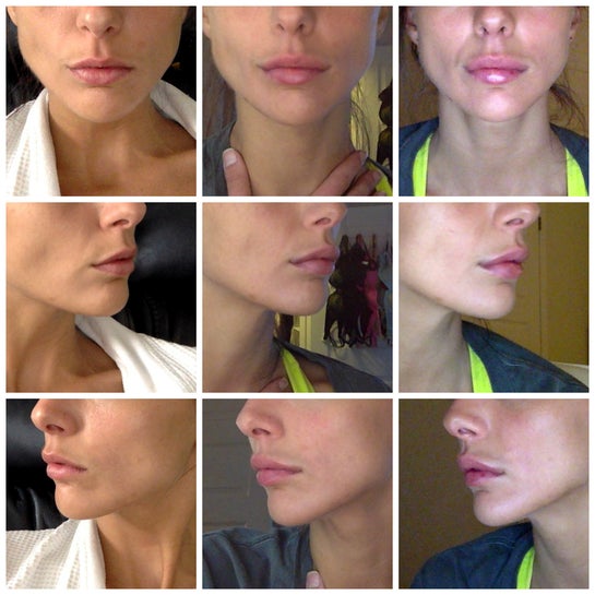 How To Get The Swelling Down After Lip Fillers