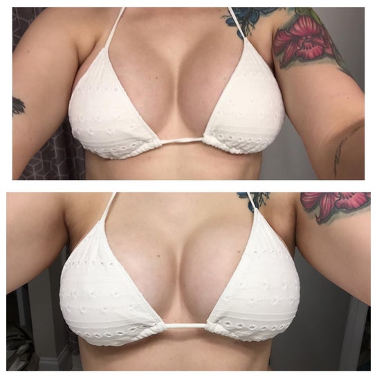 What can I do about uneven breasts at 5 months after implants? (photos)