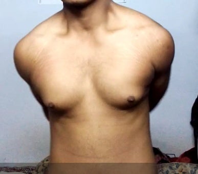 20 Minute Post gynecomastia surgery workout for at home