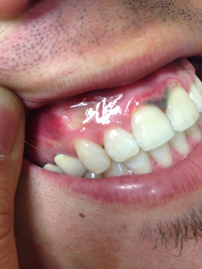 Grey And Black Gums After Professional Teeth Whitening Photo