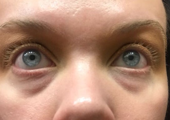 Under Eye Fillers - The Solution to Undereye Bags? - James Christian New  York's Injectable Expert