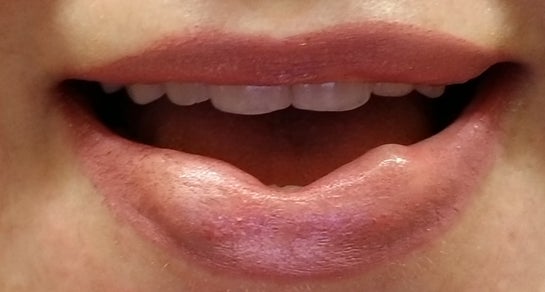  Are Small Lumps Normal After Lip Fillers Sitelip