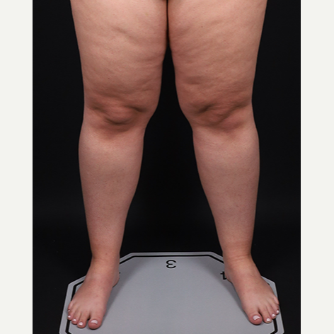 Lipedema Series Part V: Patient Story - Living with Lipedema by Dr. David  Amron - Issuu