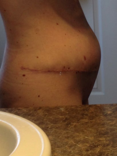 What is my recovery time and risks for hematoma post-tummy tuck with  evacuation? (photo)