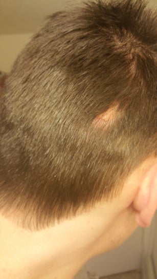 Nevus Sebaceous Removal Before And After