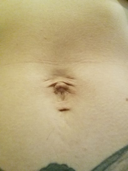 Can A Basic Umbilicoplasty Procedure Repair Remove Ugly Scar Tissue Left By Navel Piercings Photo