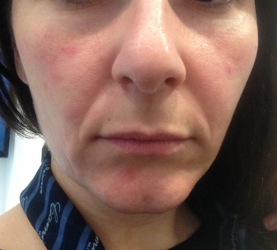 retinoid cream for rosacea