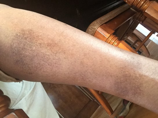 How can I get rid of old scars on my legs from a hot water burn? (Photos)