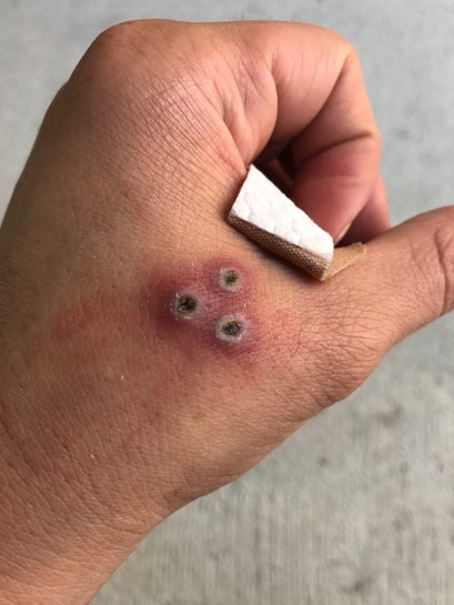 This 3 Dot Tattoo Is In The Processing Of Removal Via Glycolic Acid Post 2 Weeks Does This Tattoo Look Infected Photo