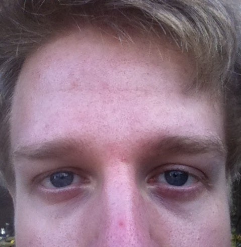 ipl for dark circles before and after