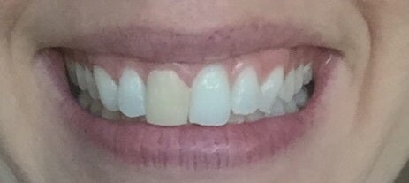 What should a front tooth temporary crown look like?