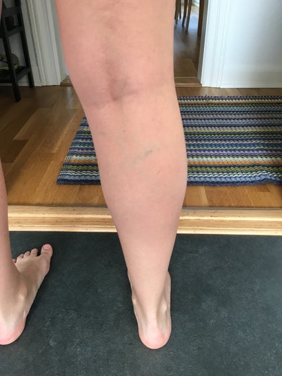 I have very visible green veins on my legs. Can these be treated