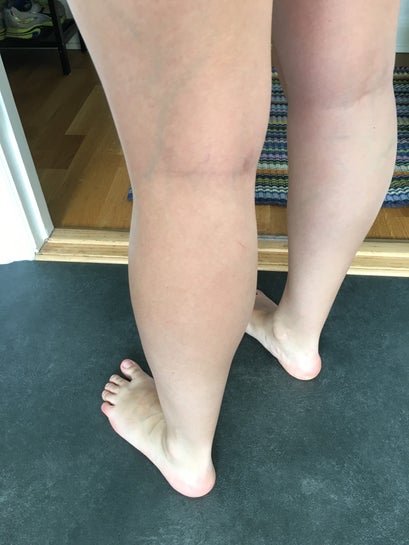 I have very visible green veins on my legs. Can these be treated