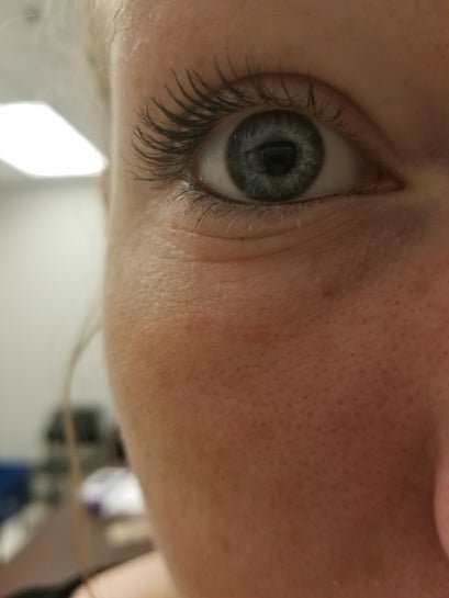 fine lines under eyes at 23