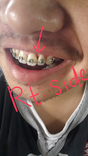 Triangle braces online for teeth