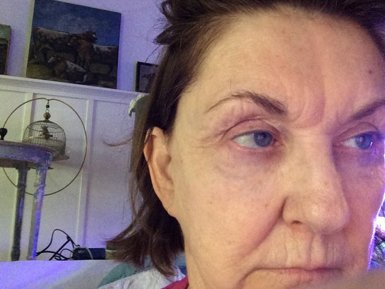 vertical wrinkles under eyes