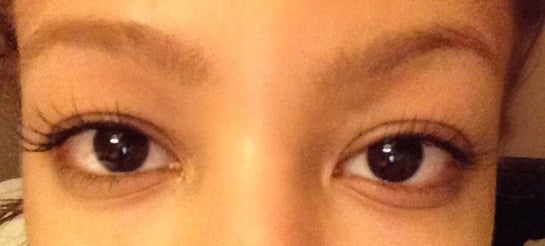 genetic under eye creases