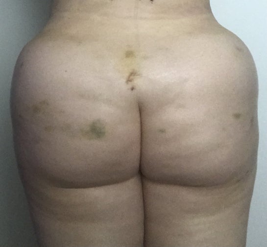 Did my surgeon place the fat incorrectly/lack skill (tombstone BBL result)?  (Photos)