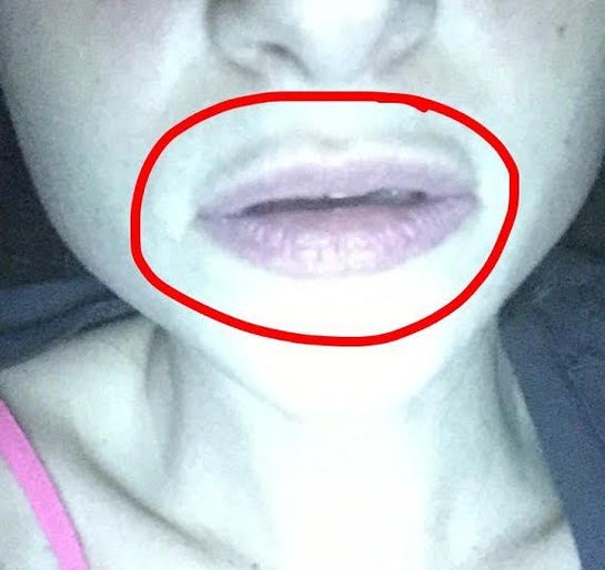 Why Do I Have A White Line Above My Lips