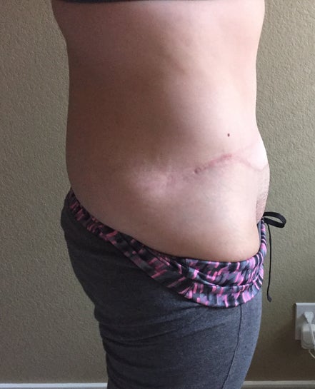 Having Lipo in Mon Pubis After Tummy Tuck: Will Lipo be Enough and How Long  is the Healing Process? (Photo)