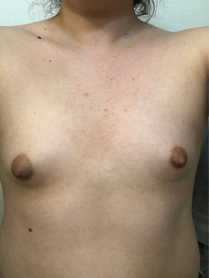 Do I have tubular breasts? If so, what could I do to fix them? (Photo)