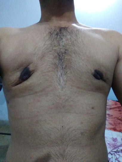 55 days (almost 2 months) after gynecomastia surgery. Crater and uneven  shape. (Photos)