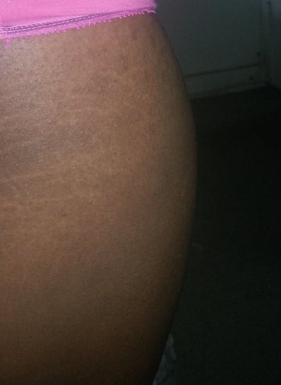 ambi for stretch marks