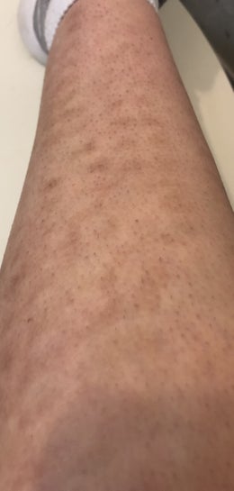 Is it normal for my skin to be this blotchy after hair laser