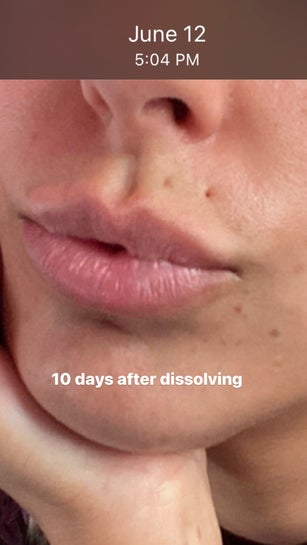 2 Line Filler – So Far Lost Second smile line - how do you get rid of this? (Photo)