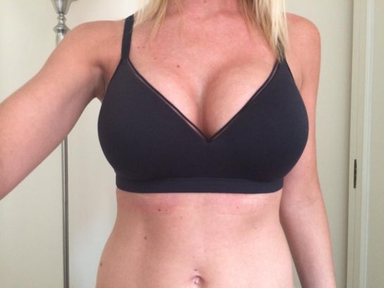 1 week post-op, will I now always have one boob bigger than the other?  (photos)