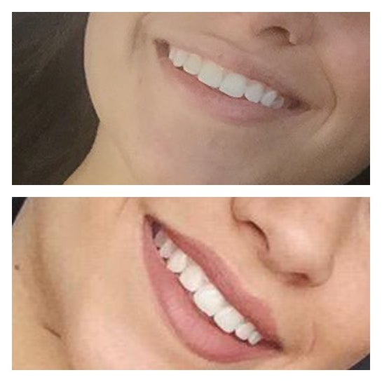 How Do I Fix My Two Big Front Teeth Photos