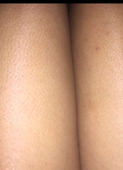 Does laser hair removal get rid of strawberry legs Photos