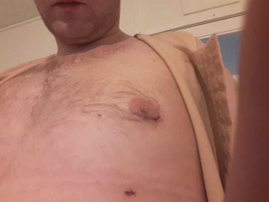 When can I smoke after gyno surgery? (Photos)