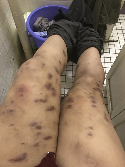 I have horrible dark scars on my legs. I've heard from 3 different doctors  MRSA, staph, and hidradentis supprativa. Help (Photo)