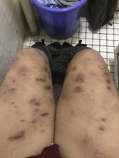 I have horrible dark scars on my legs. I've heard from 3 different doctors  MRSA, staph, and hidradentis supprativa. Help (Photo)
